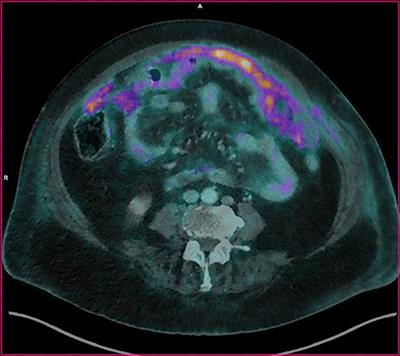 False Positive 18F-FDG Positron Emission Tomography Findings in Schwannoma—A Caution for Reporting Physicians